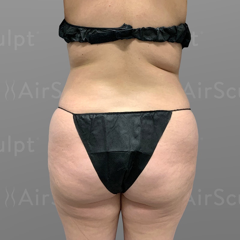 before stomach, back bra roll, power BBL AirSculpt