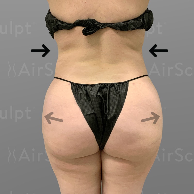 after stomach, back bra roll, power BBL AirSculpt