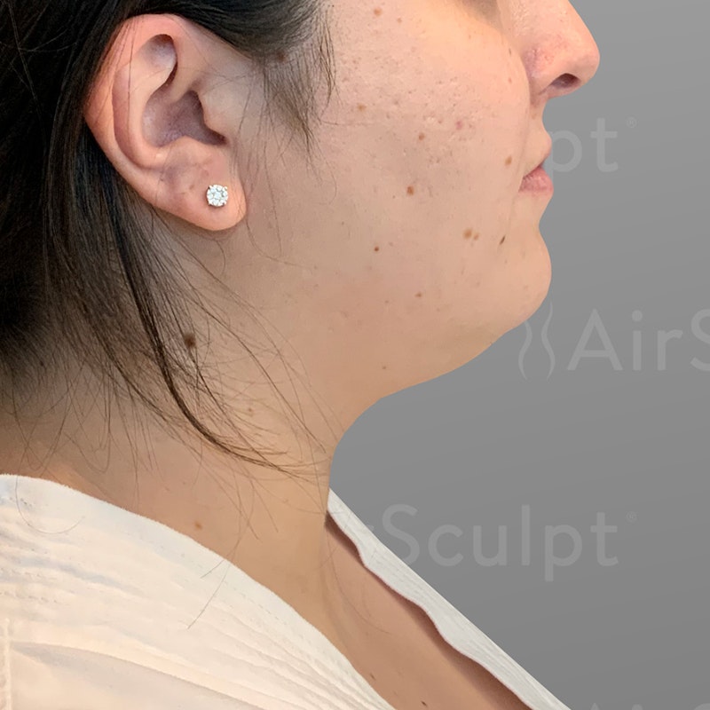 before chin airsculpt