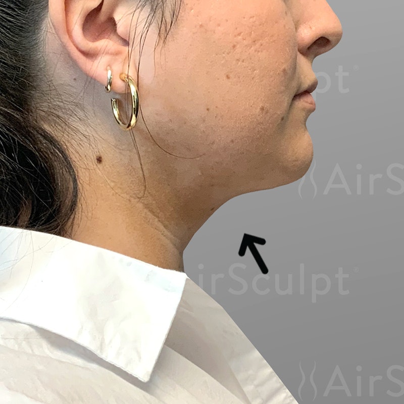 after chin airsculpt