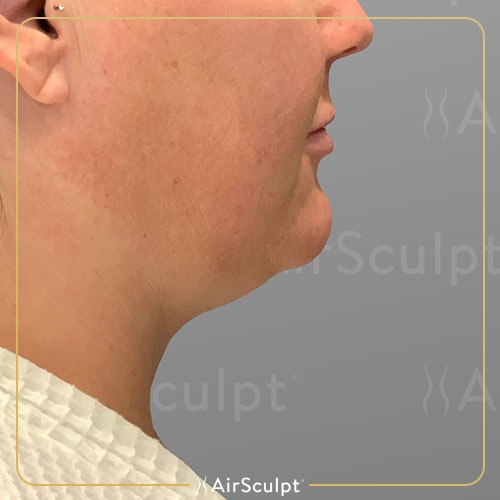 before chin airsculpt