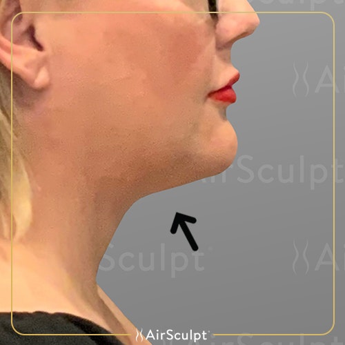 after chin airsculpt