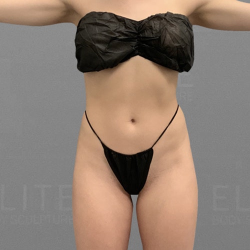 julia before airsculpt