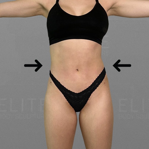 julia after airsculpt