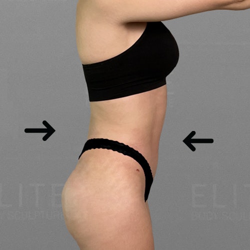 julia after airsculpt