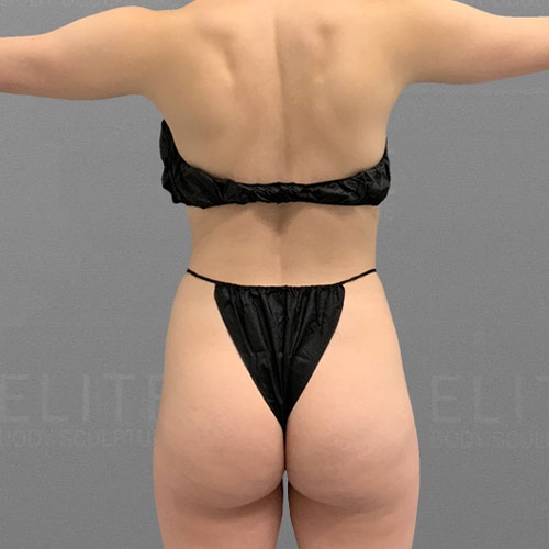 julia before airsculpt