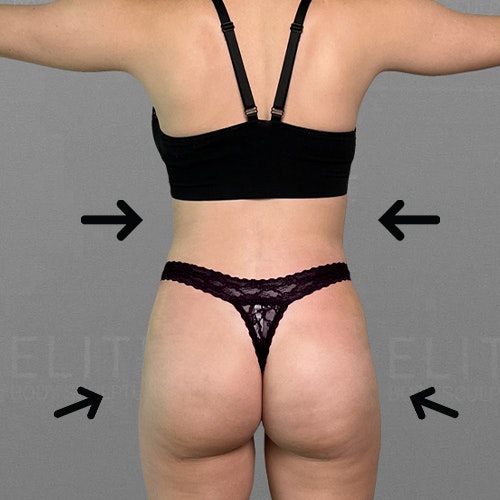 julia after airsculpt