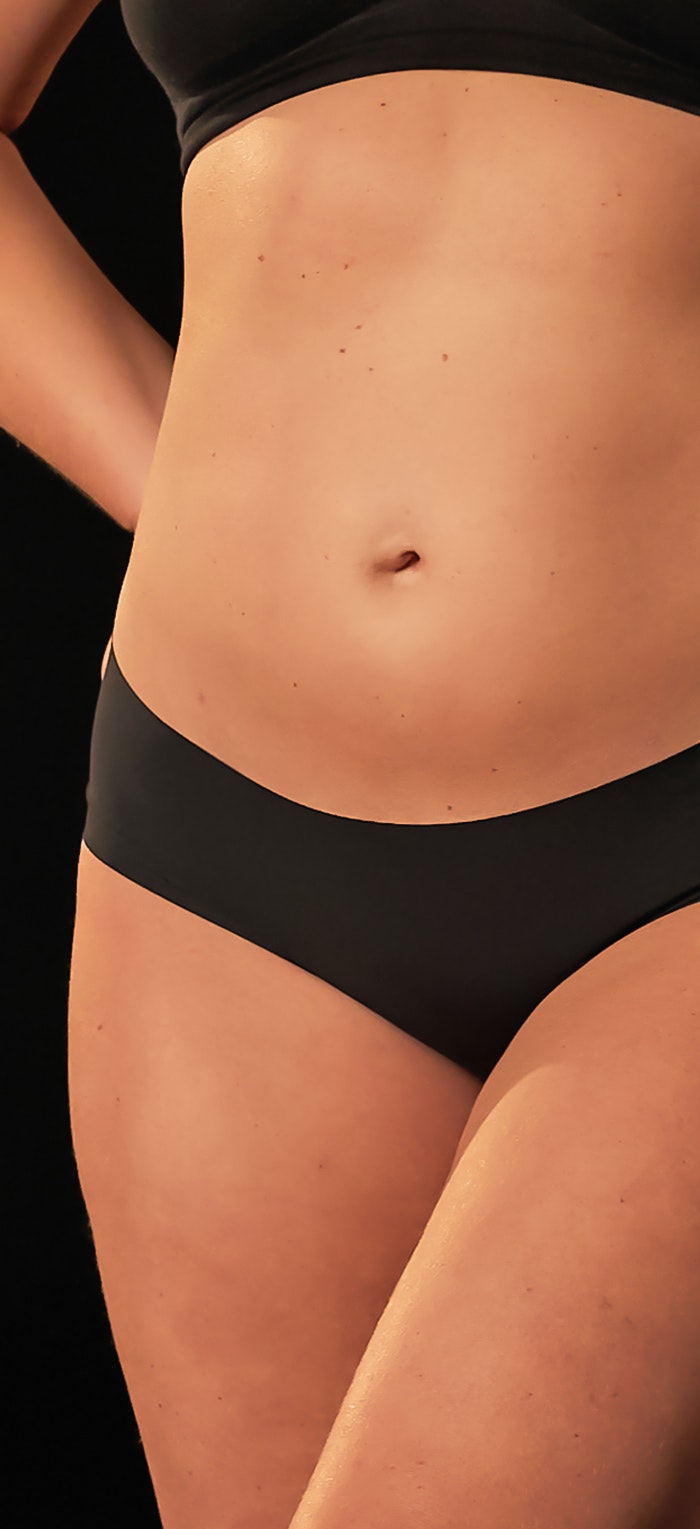 Pubic AirSculpt®  Mons Pubis Reduction