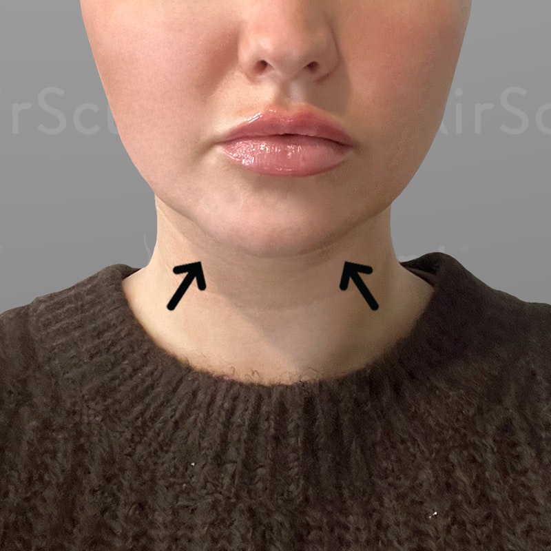 Kenzie Elizabeth one-month Chin AirSculpt result