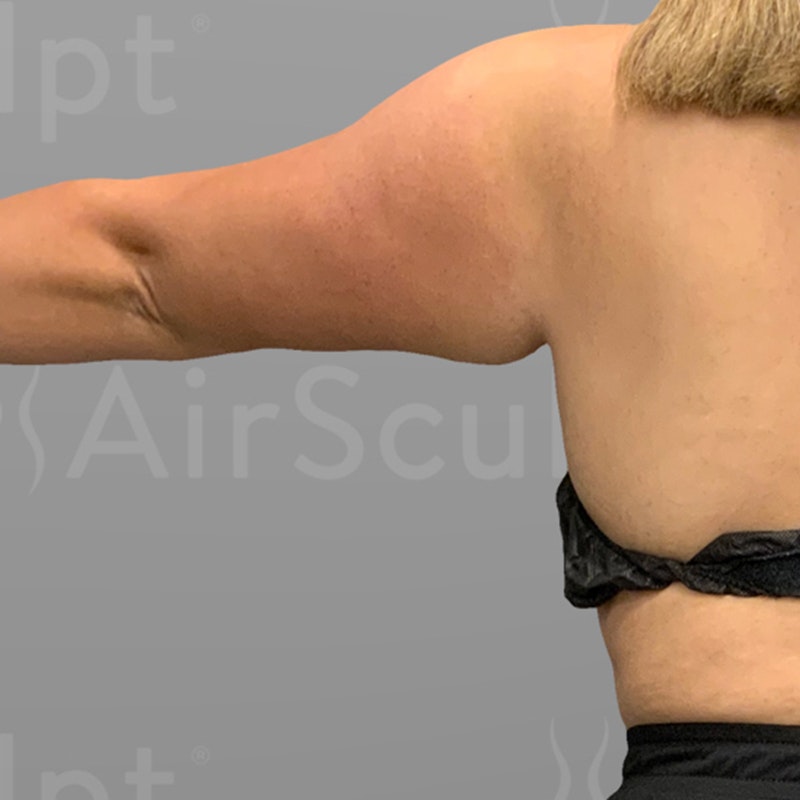before arm airsculpt+