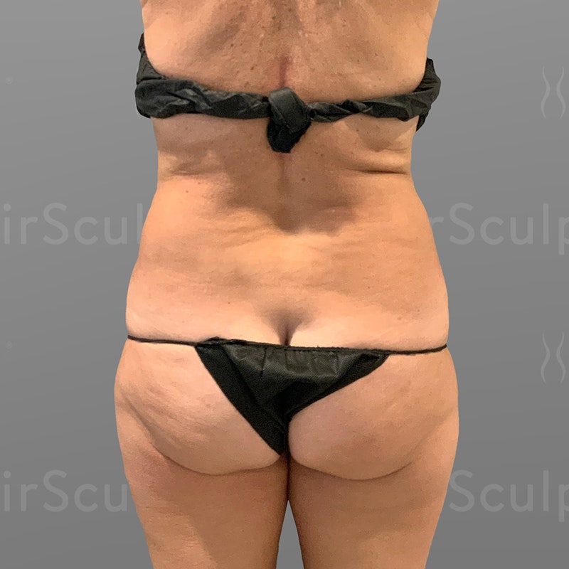 before back, waist, power BBL AirSculpt +
