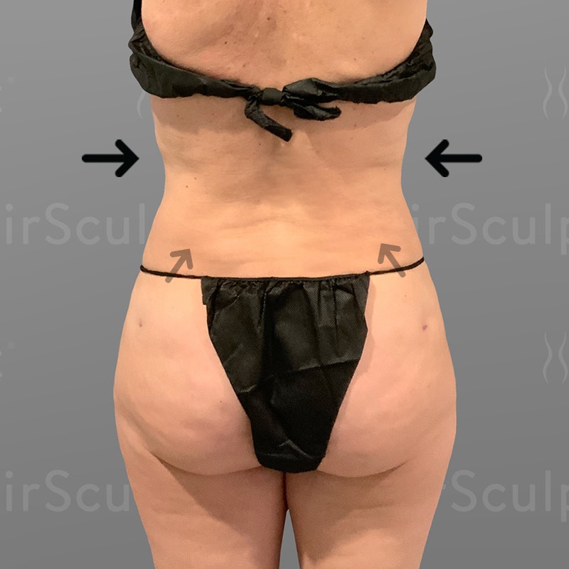 after back, waist, power BBL AirSculpt +