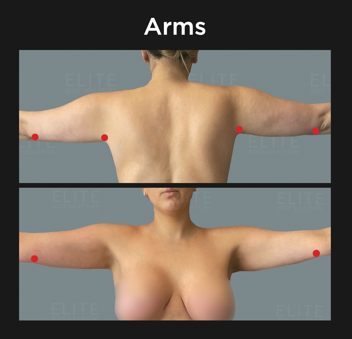 Permanent Arm Fat Removal  Arm Liposuction With AirSculpt®