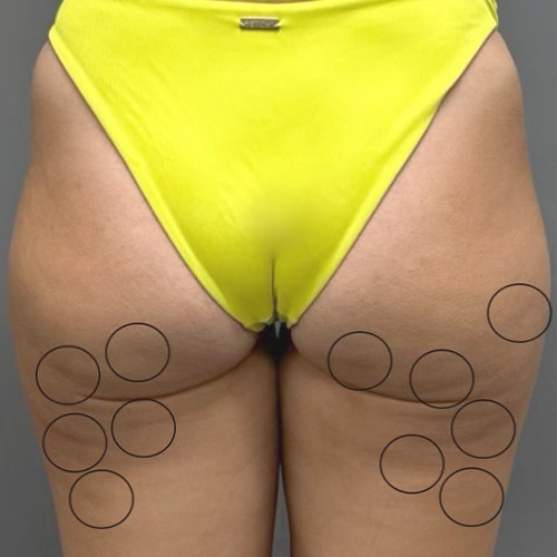 before cellulite removal AirSculpt