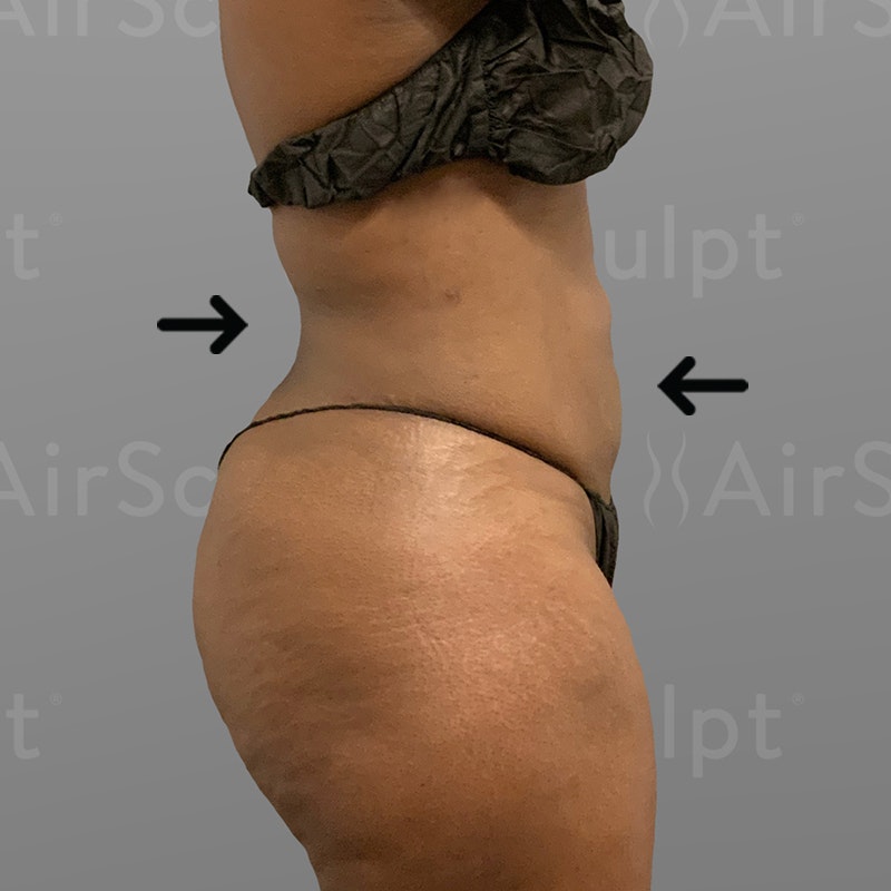 after lower back and stomach airsculpt