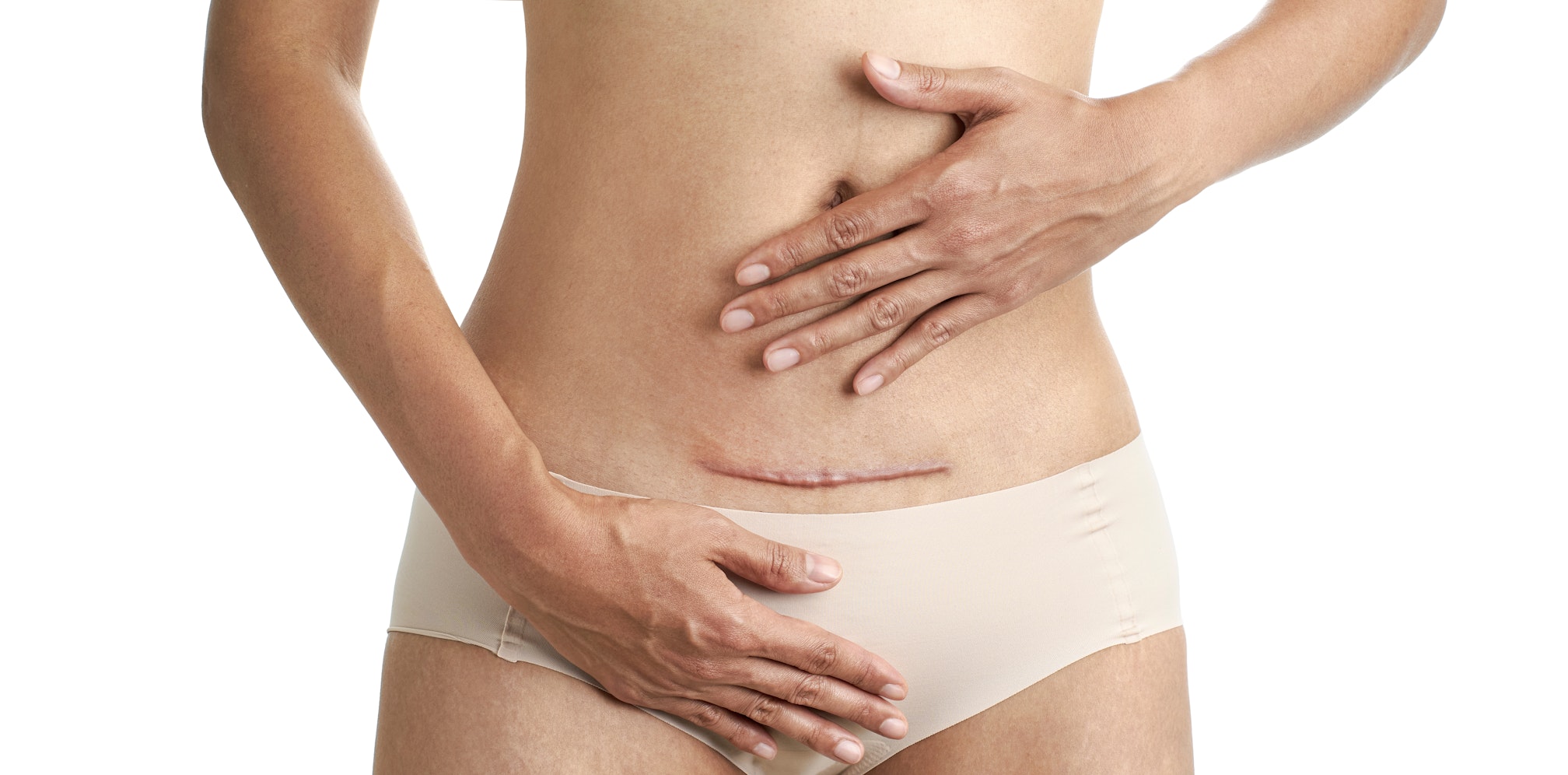 Closeup of woman belly with a scar from a cesarean section with her hands on white background