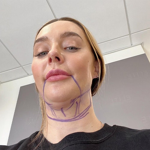 Lauryn Bosstick before image. chin marked with marker drawings