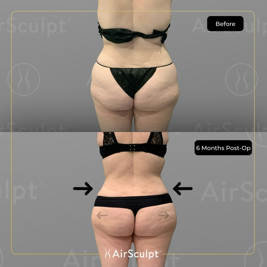 AirSculpt HipFlip before and after photo from behind
