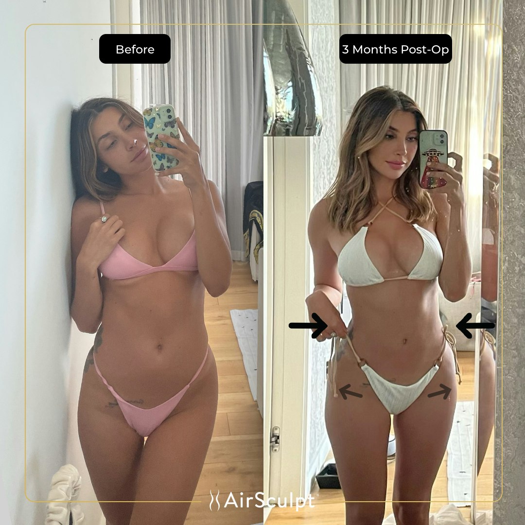Jordana Barnes before and after image selfie in the mirror showing her narrowed waist and curvier figure