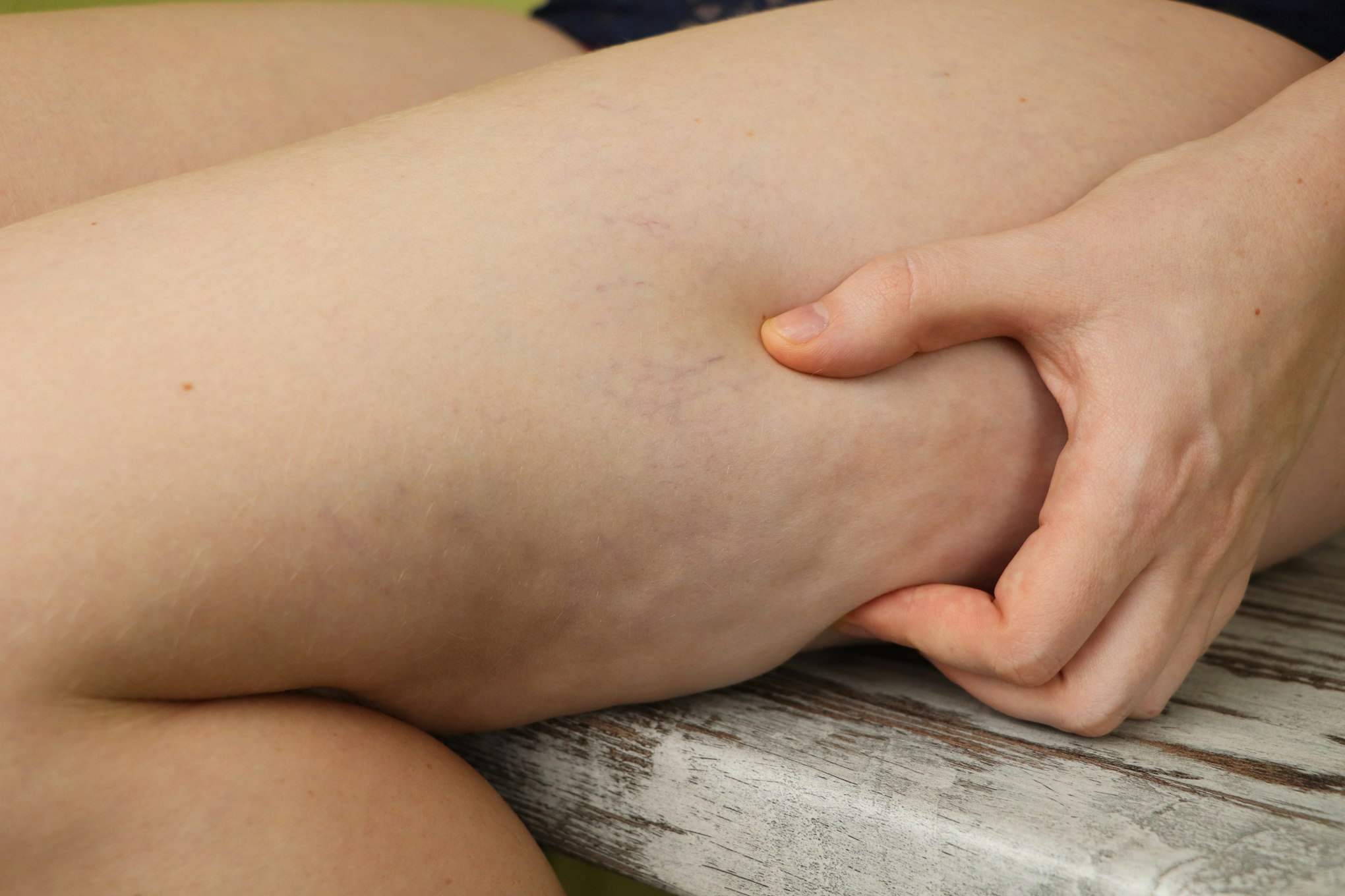 Woman shows holding and pushing the skin of the legs with fibrosis