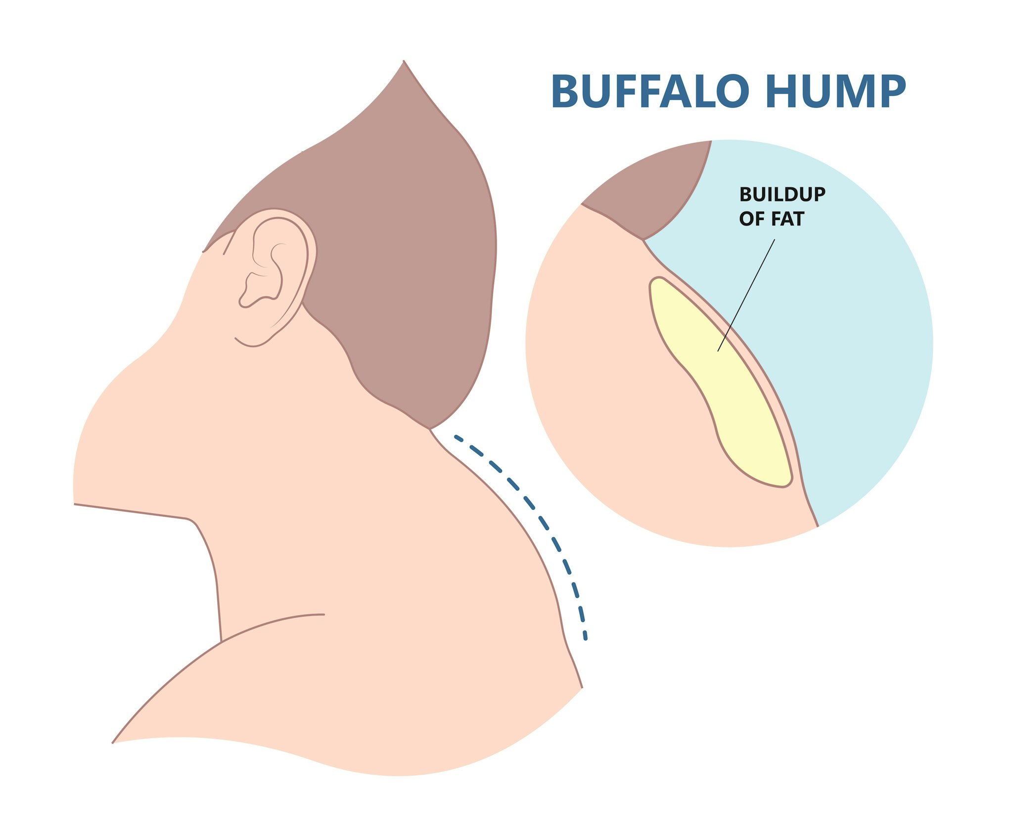 buffalo dowager's hump head bad poor women spine pad excess shape