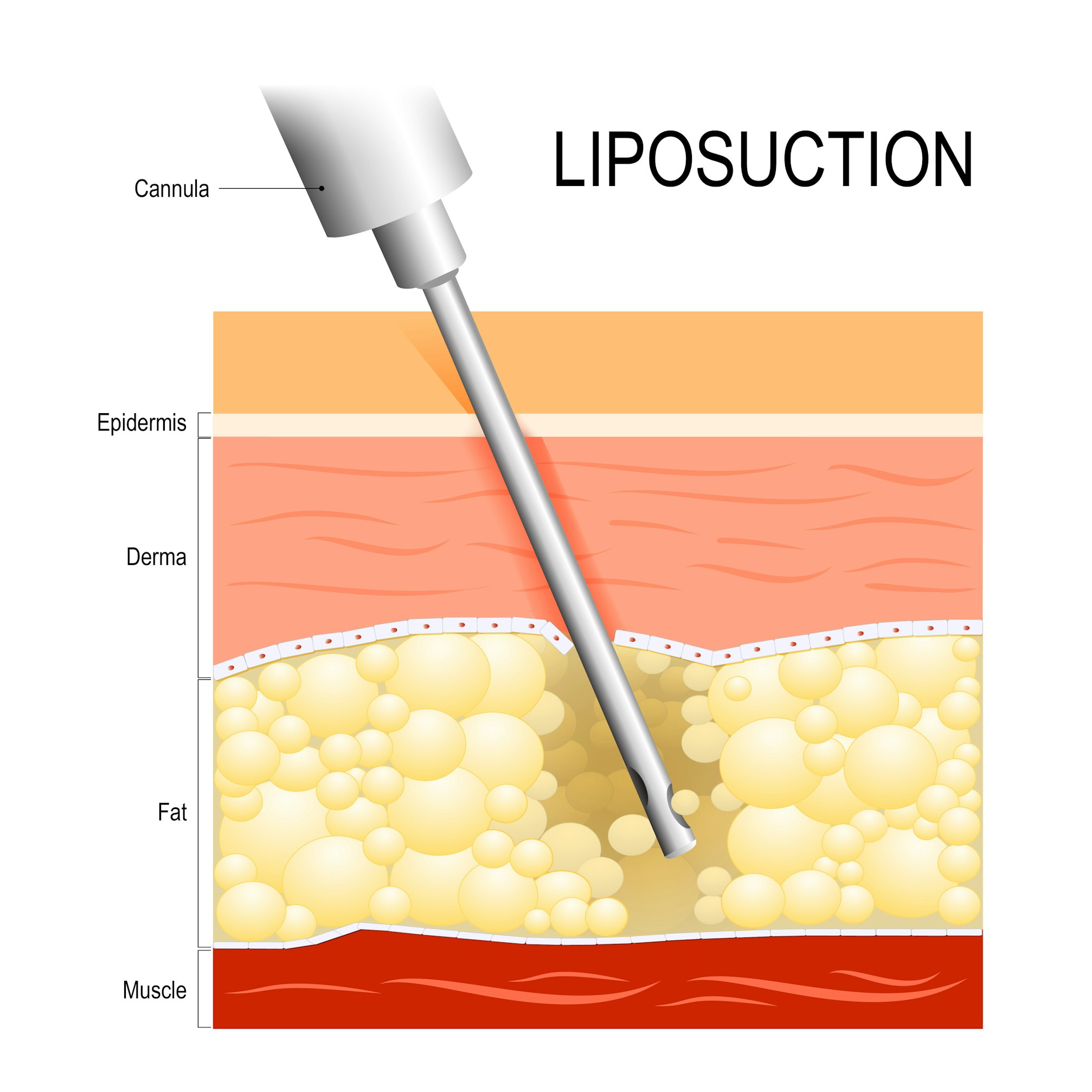 image of liposuction cannula and the different fat and skin layers
