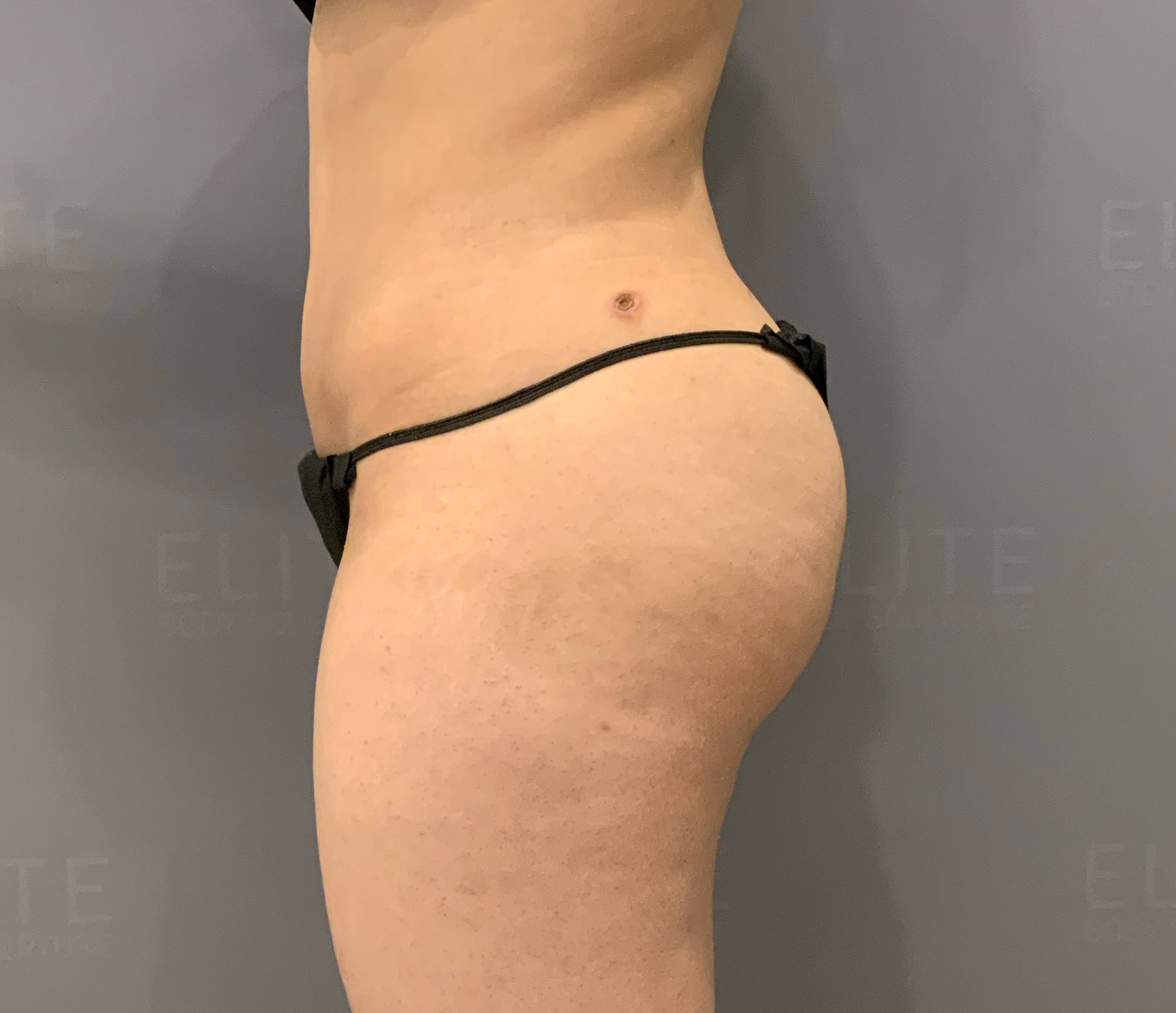48 hour post-op BBL Scar picture 