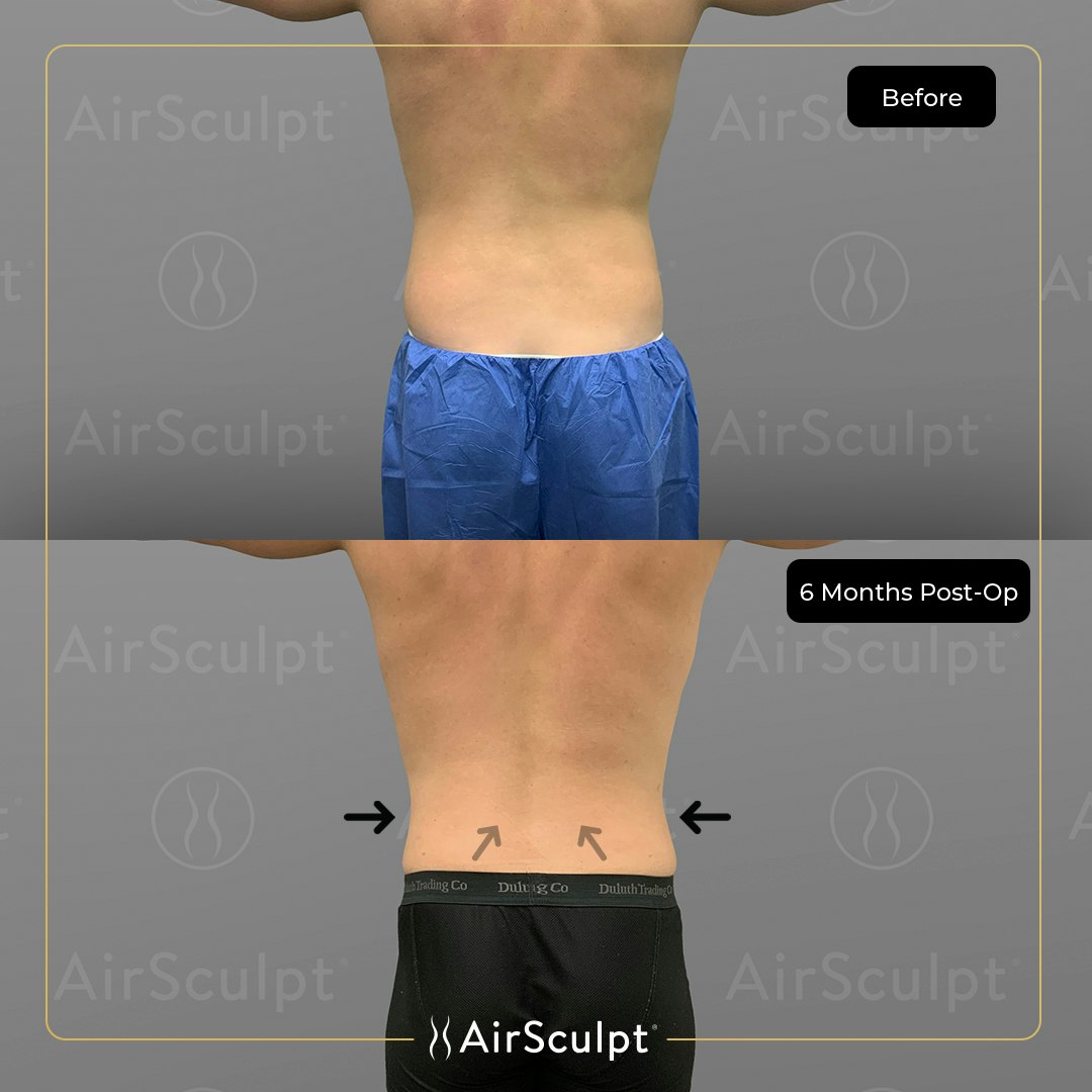 drew before and after airsculpt