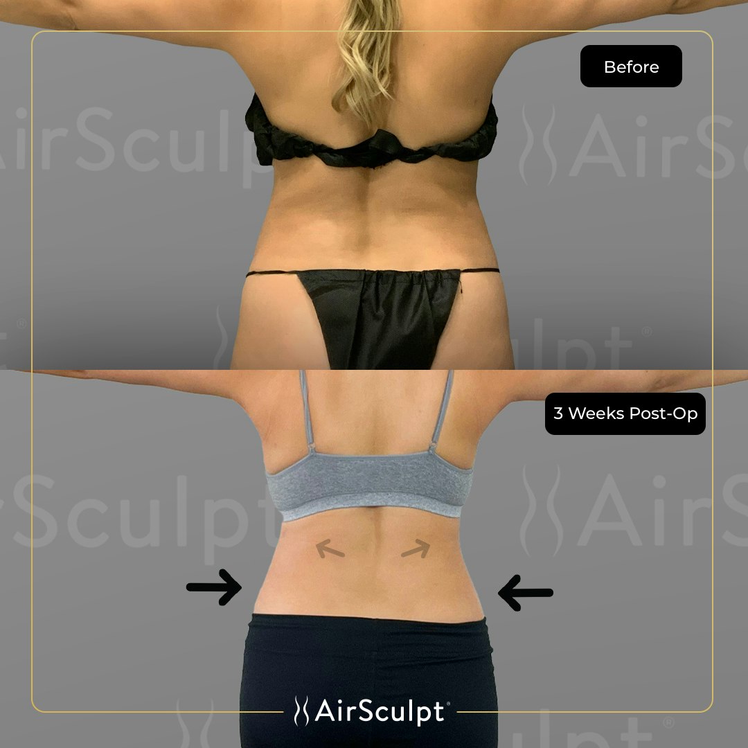 Back AirSculpt®  Permanent Back Fat Removal