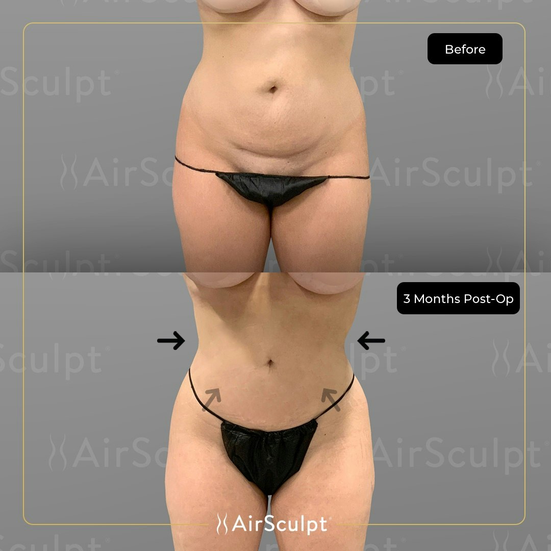 A Flatter Tummy and Naturally Enhanced Breasts: What AirSculpt Did