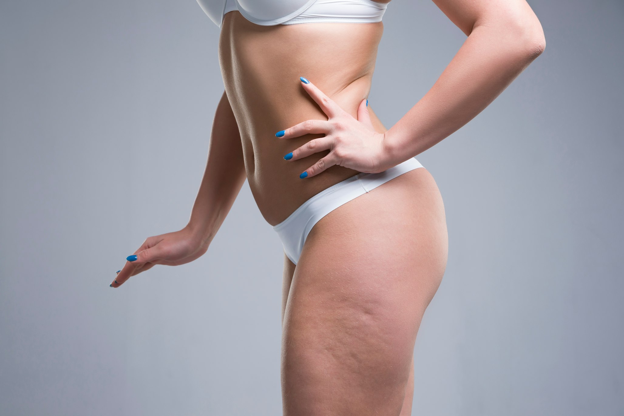 What Causes Cellulite & Where Is It Most Common?