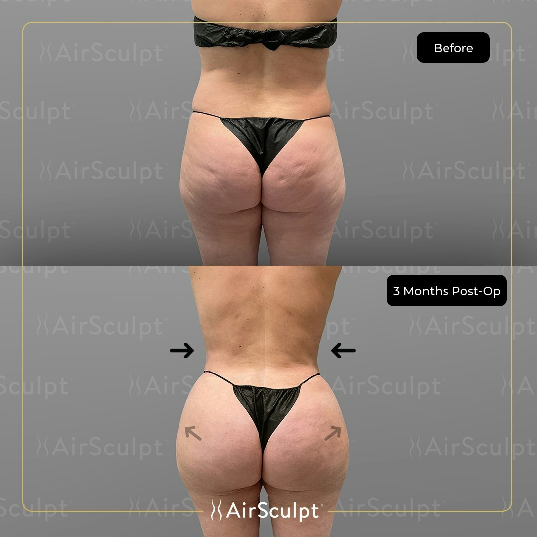 AirSculpt BBL before and after