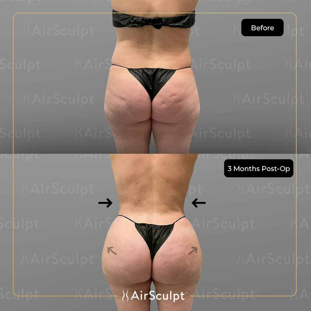 BBL vs. Butt Lift: How They Differ