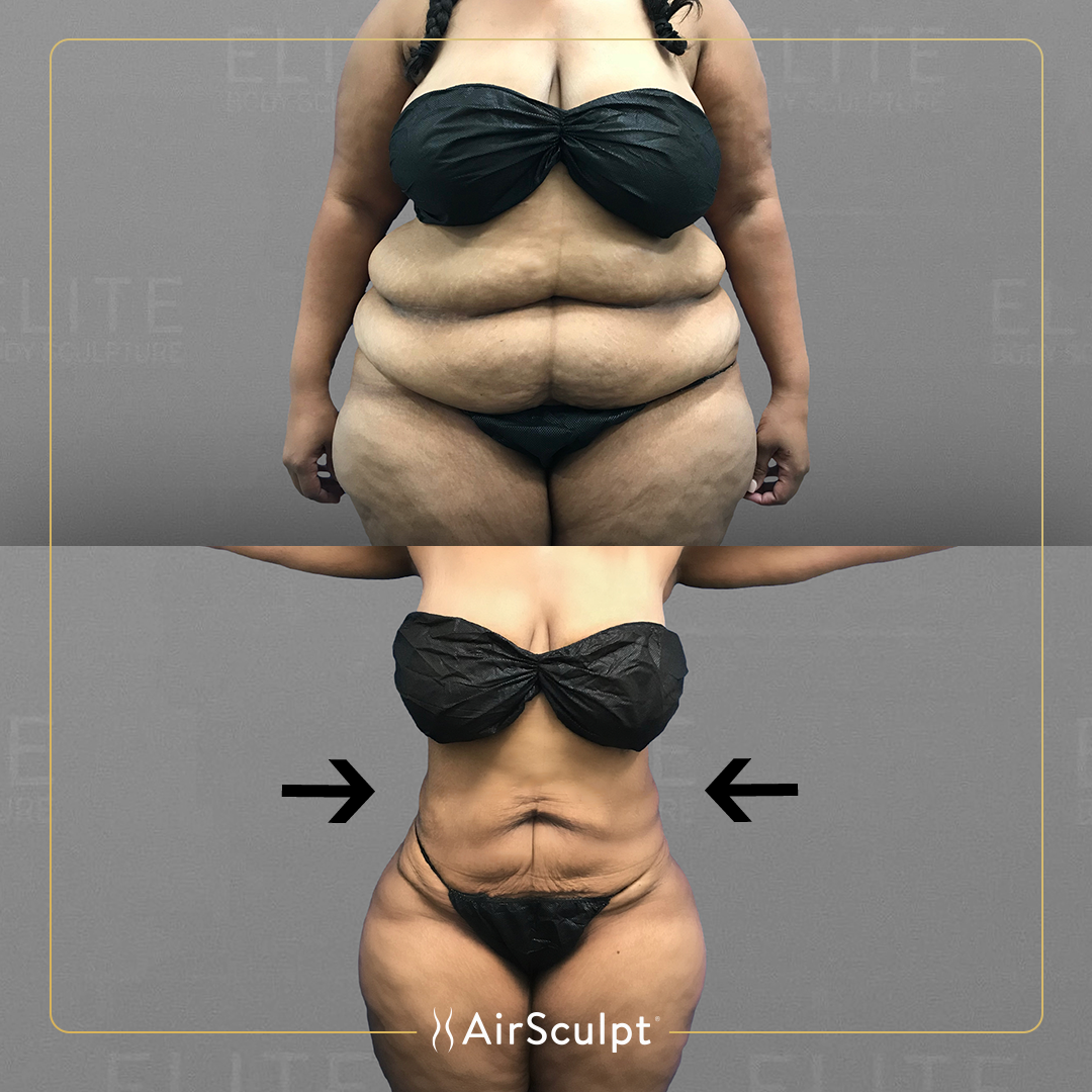 Large Volume Liposuction: How Much Fat Can Be Removed?