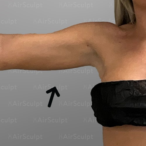 after arm fat removal