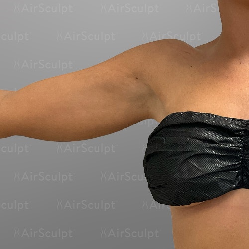 before arm fat removal