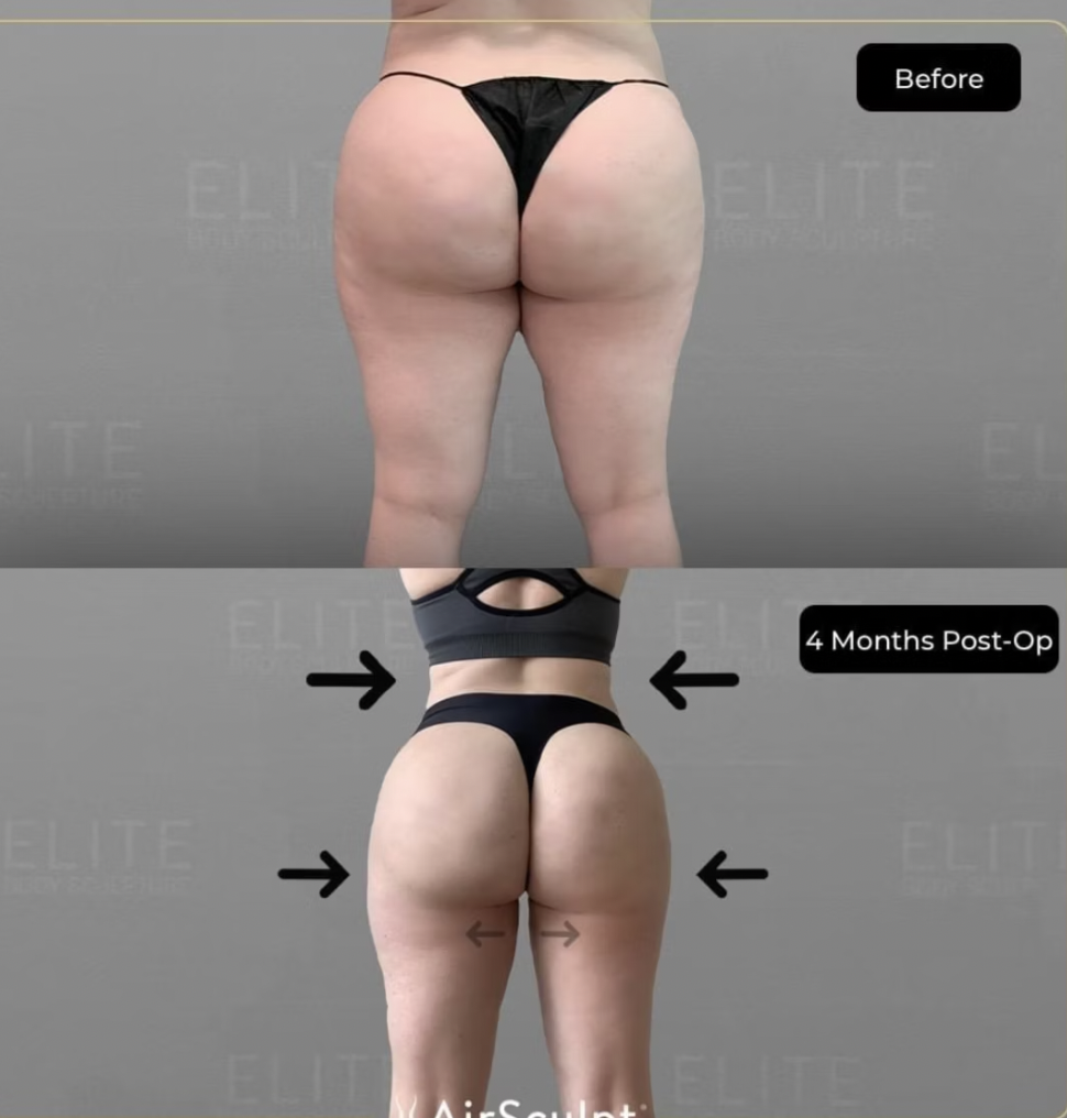 Amy's before and afters thigh airsculpt