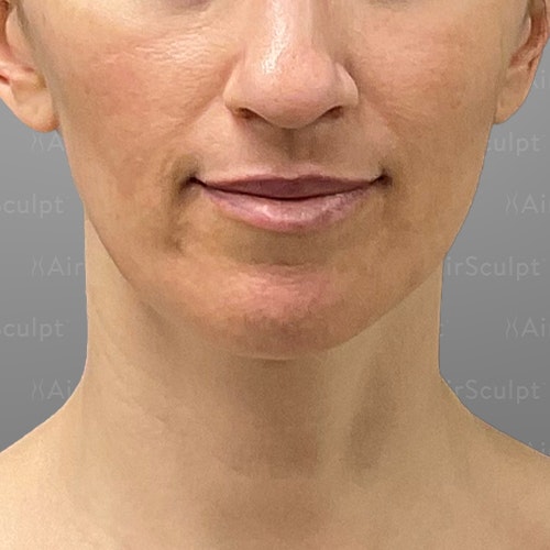 before airsculpt lift