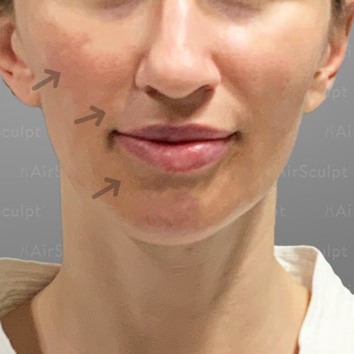 after airsculpt lift