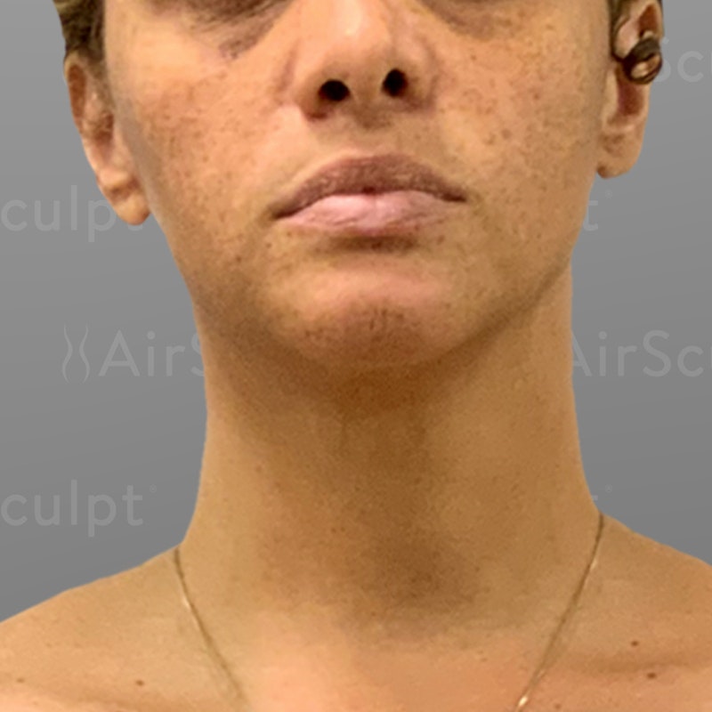 before airsculpt lift