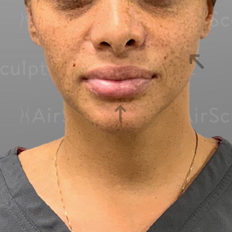 after airsculpt lift