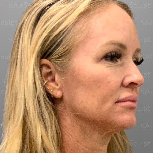before airsculpt lift