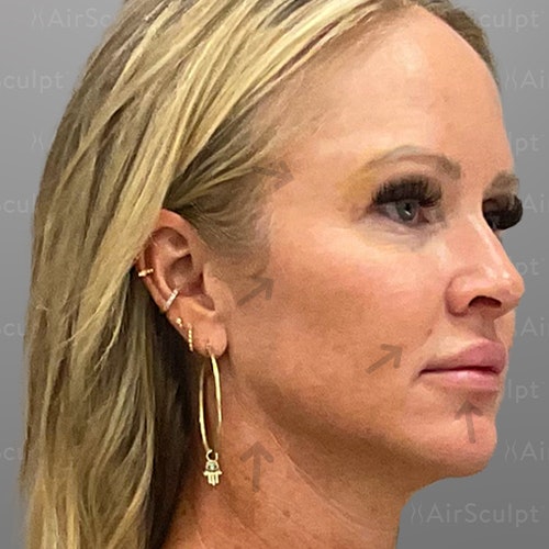 after airsculpt lift