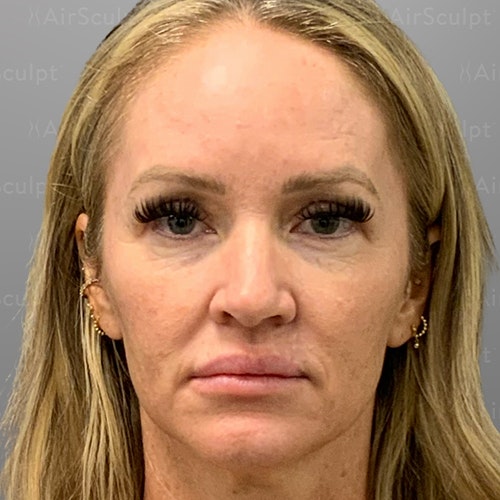before airsculpt lift