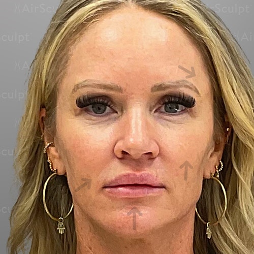after airsculpt lift