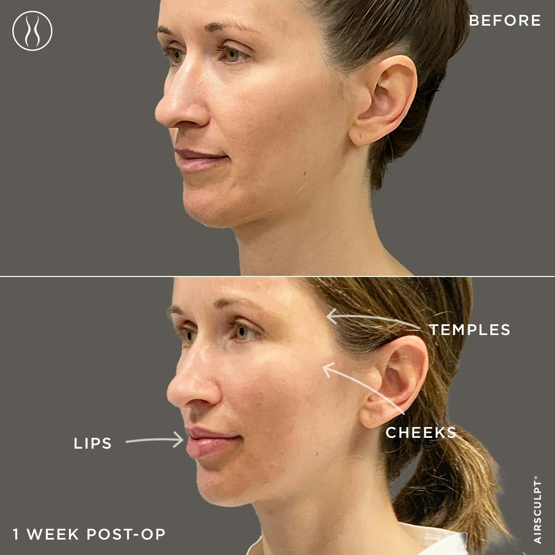 facial fat grafting with the airsculpt lift before and after photo