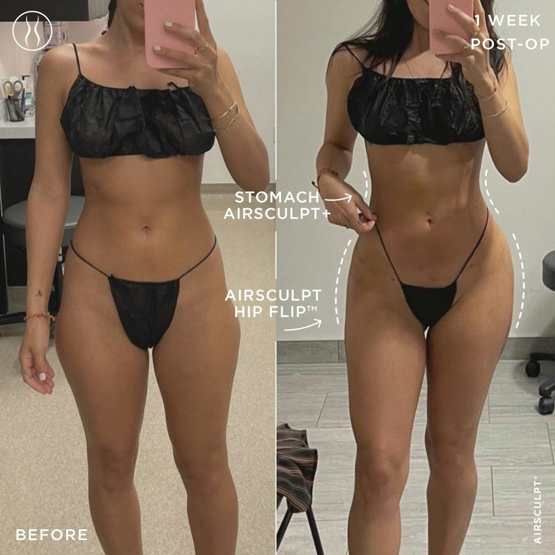 hip flip before and after one week
