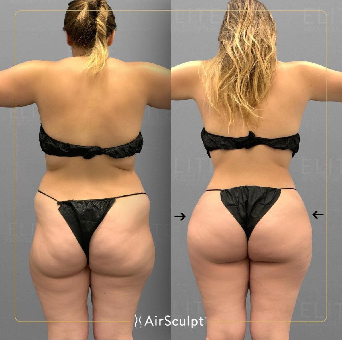 hip dip before and after