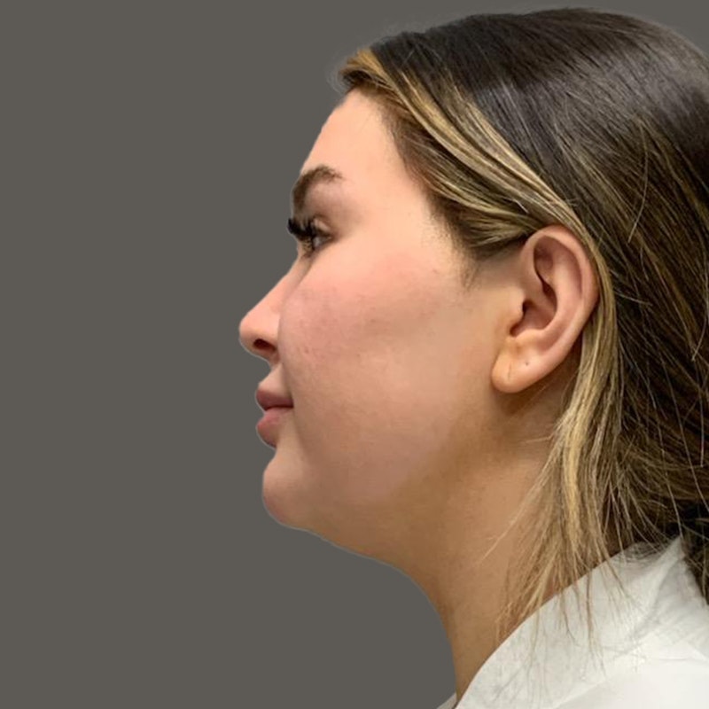 Madi Bernard before AirSculpt