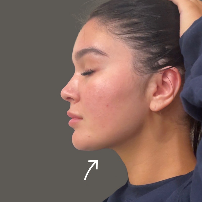 Madi Bernard after AirSculpt